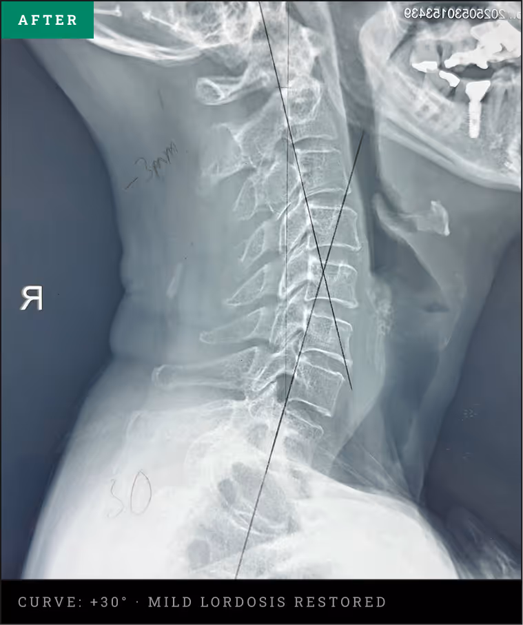 Lateral cervical spine X-ray showing restored cervical lordosis after structural correction