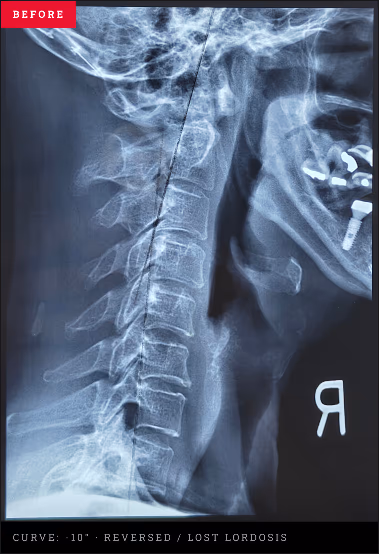 Lateral cervical spine X-ray showing a reversed neck curve before structural correction